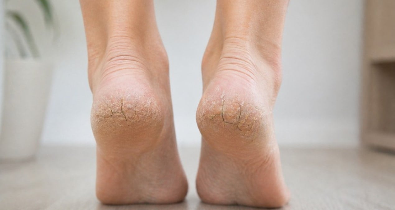 Topuk Çatlaklarından Kurtulmanın Pratik Yolu: Sadece 15 Dakika Yeter
